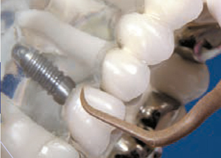 Acteon насадка для скайлера PH2R – из карбонового композита, для полировки и чистки керамических и композитных виниров, вкладок, обработки шеек имплантатов и протезов, полировки металлических (золото, титан) поверхностей