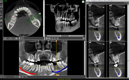 FONA XPan 3D - рентгенографическая цифровая система панорамной съемки